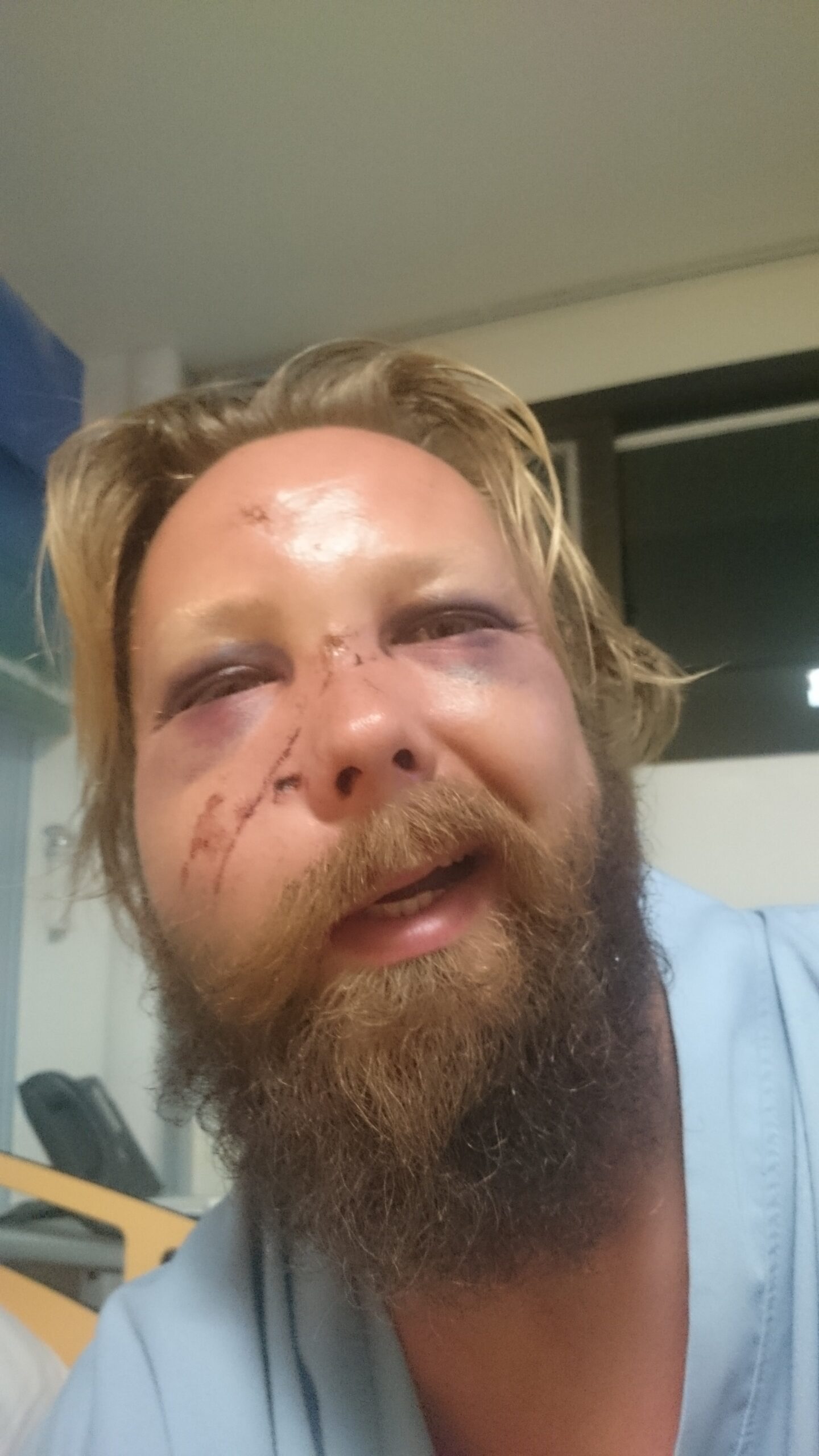 Slik så Raymond ut etter overfallet i Thailand. Det skumleste var uansett ranet i Mexico.